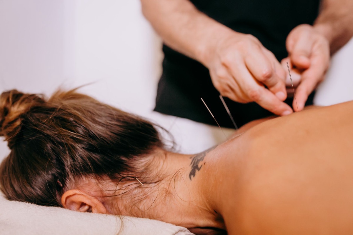 Fisioterapeuta aplicando agujas de punción seca en el trapecio de una paciente tumbada en camilla en El Albir, Alicante