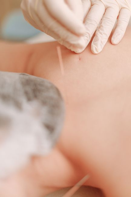 Primer plano de un fisioterapeuta con guantes insertando una aguja de punción seca en el hombro de un paciente en el Centro Terapéutico SOMA, El Albir